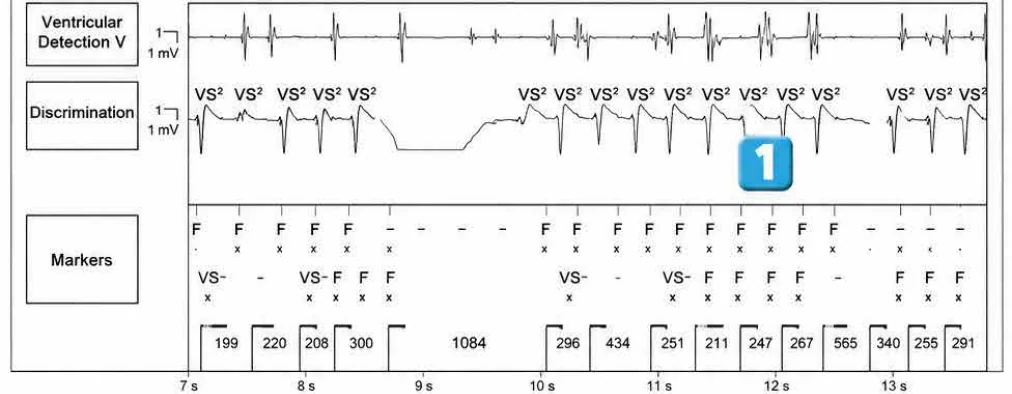 Abbott ICD electrogram, segment 1 of 4 — Surgery and use of an electric scalpel