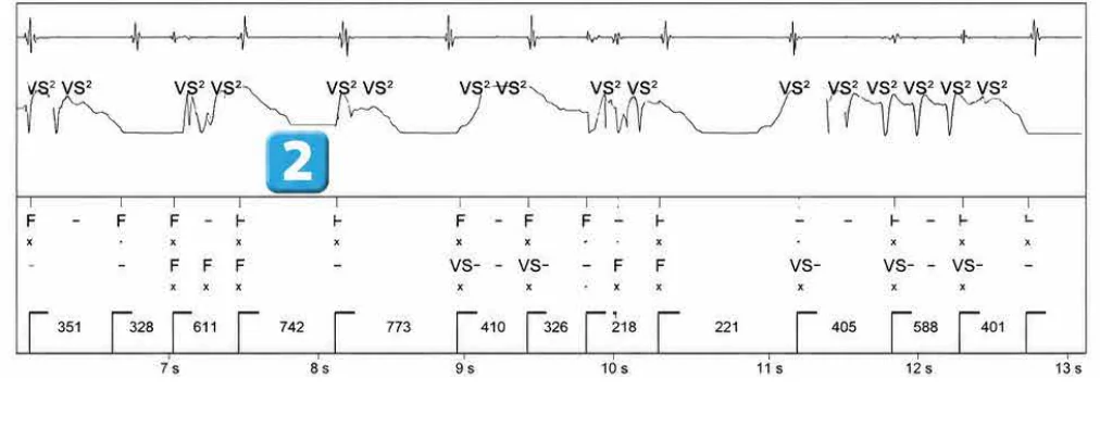 Abbott ICD electrogram, segment 2 of 4 — Surgery and use of an electric scalpel