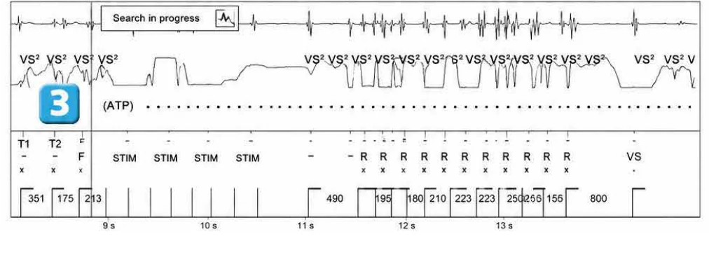 Abbott ICD electrogram, segment 3 of 4 — Surgery and use of an electric scalpel