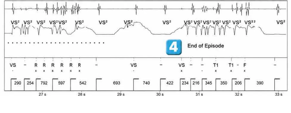 Abbott ICD electrogram, segment 4 of 4 — Surgery and use of an electric scalpel