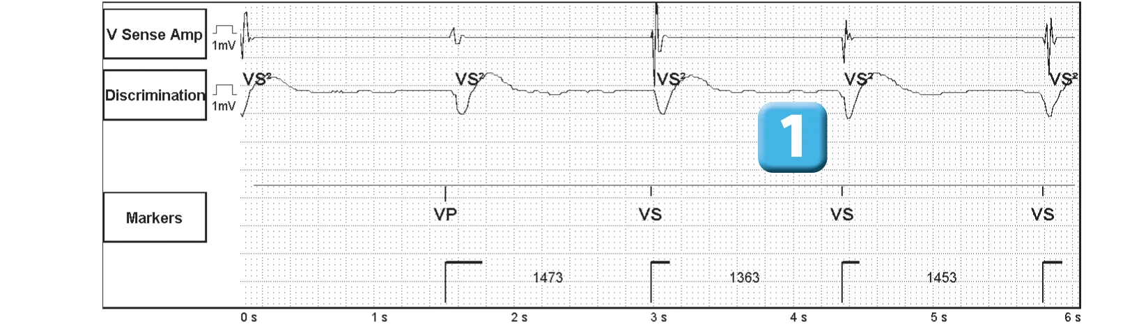 Abbott ICD electrogram, segment 1 of 3 — SecureSense™ algorithm and undersensing on the discrimination channel