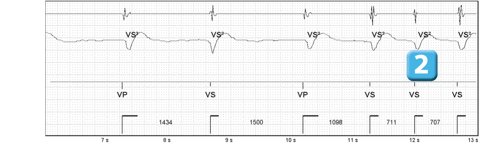 Abbott ICD electrogram, segment 2 of 3 — SecureSense™ algorithm and undersensing on the discrimination channel