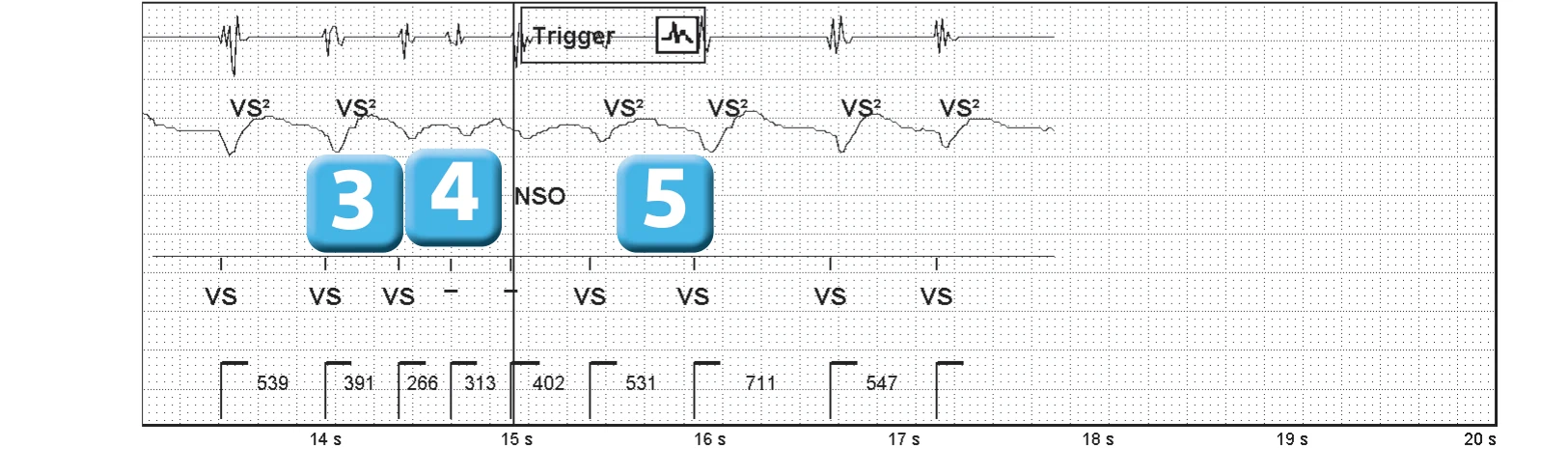Abbott ICD electrogram, segment 3 of 3 — SecureSense™ algorithm and undersensing on the discrimination channel