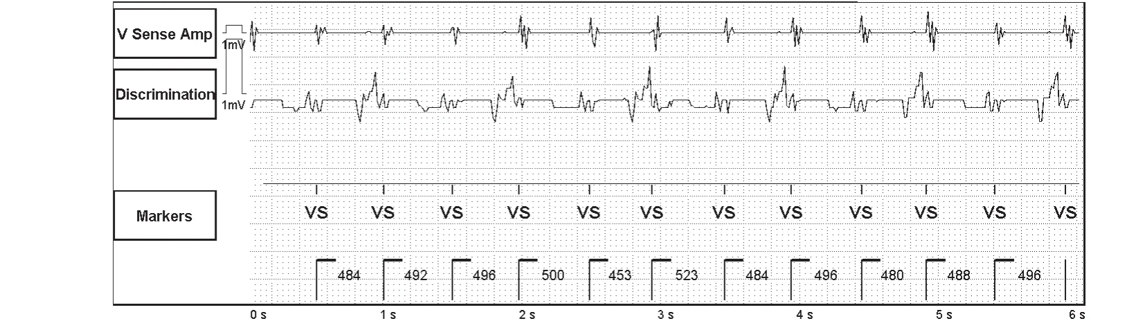 Abbott ICD electrogram, segment 1 of 4 — SecureSense™ algorithm and undersensing on the discrimination channel