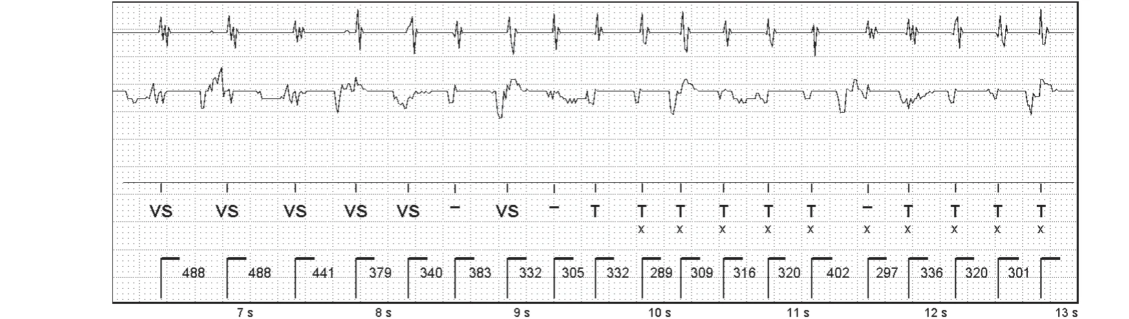 Abbott ICD electrogram, segment 2 of 4 — SecureSense™ algorithm and undersensing on the discrimination channel