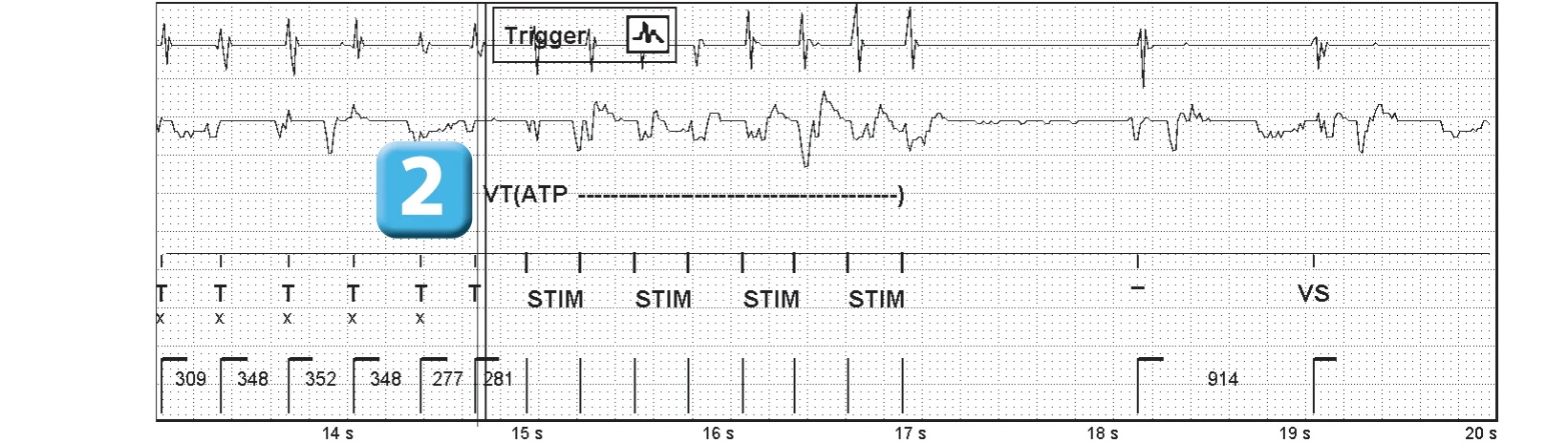 Abbott ICD electrogram, segment 3 of 4 — SecureSense™ algorithm and undersensing on the discrimination channel
