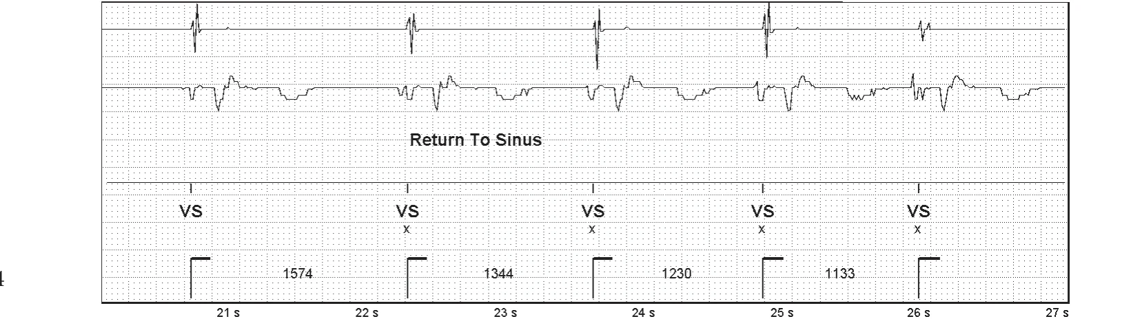 Abbott ICD electrogram, segment 4 of 4 — SecureSense™ algorithm and undersensing on the discrimination channel