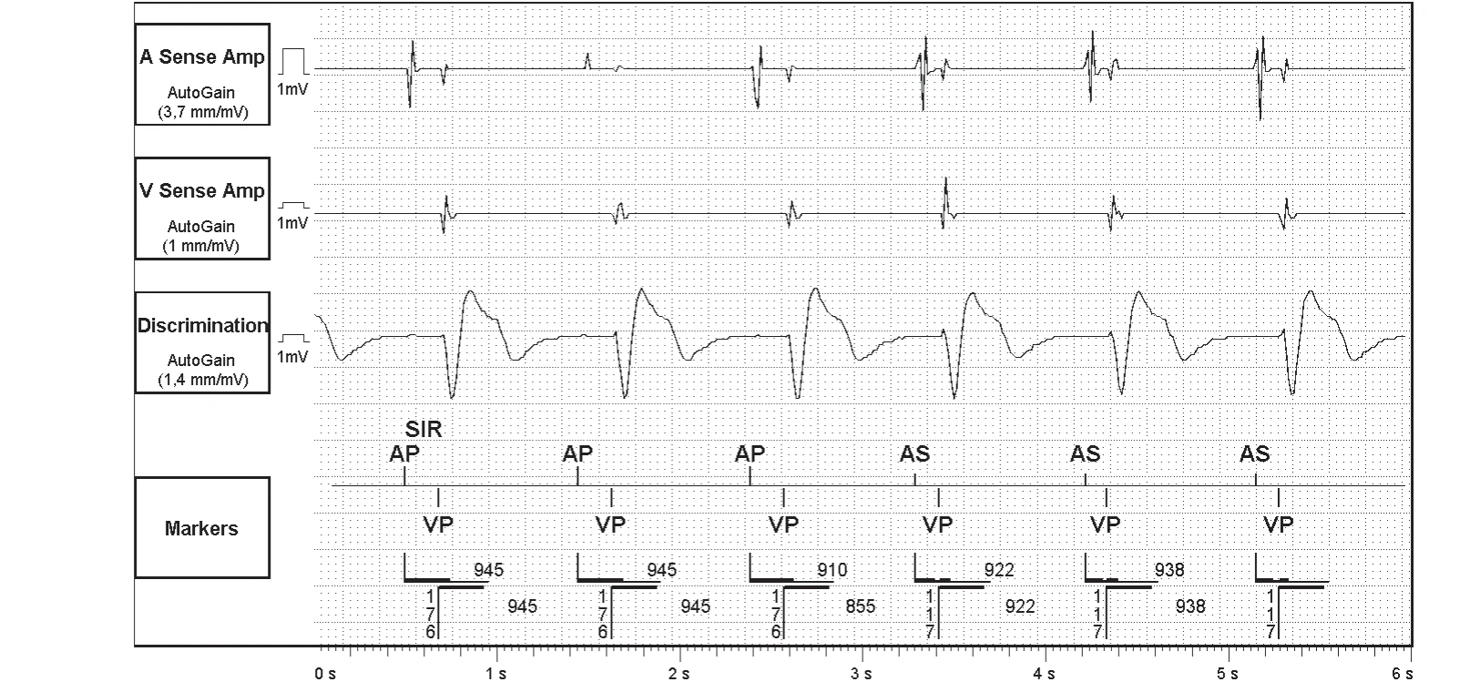 Abbott ICD electrogram, segment 1 of 3 — SecureSense™ algorithm and loss of right ventricular capture