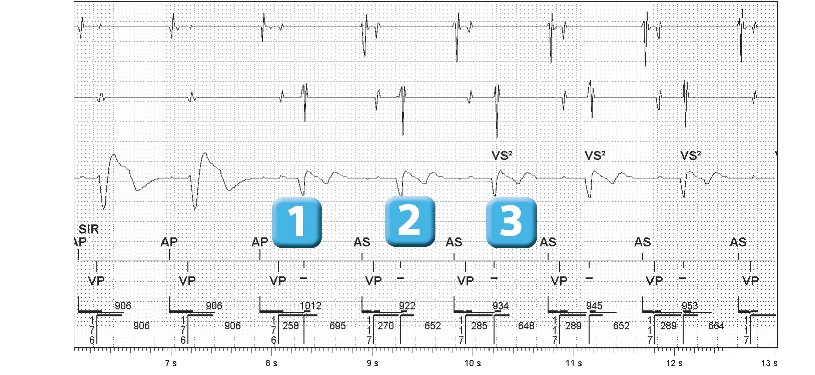 Abbott ICD electrogram, segment 2 of 3 — SecureSense™ algorithm and loss of right ventricular capture