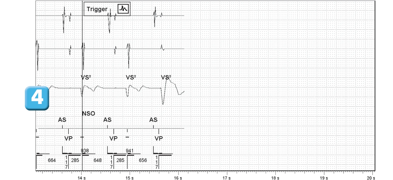 Abbott ICD electrogram, segment 3 of 3 — SecureSense™ algorithm and loss of right ventricular capture