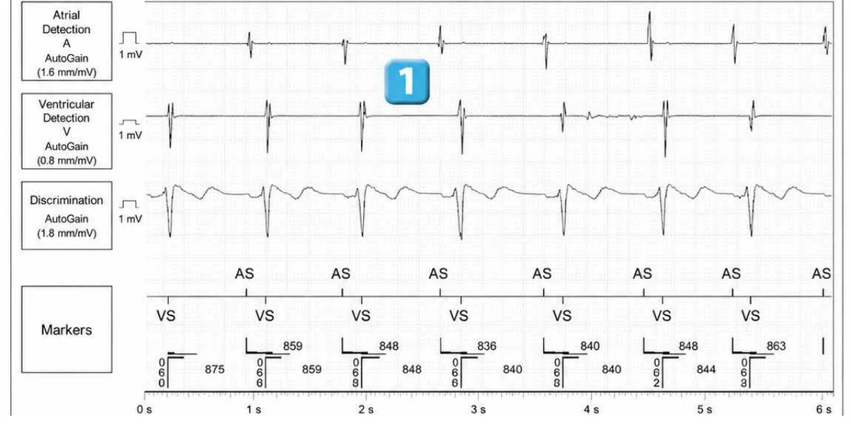 Abbott ICD electrogram, segment 1 of 4 — Recent device, lead malfunction, and SecureSense™ algorithm