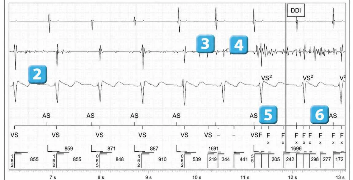 Abbott ICD electrogram, segment 2 of 4 — Recent device, lead malfunction, and SecureSense™ algorithm