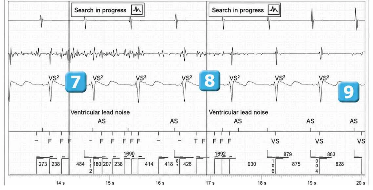 Abbott ICD electrogram, segment 3 of 4 — Recent device, lead malfunction, and SecureSense™ algorithm