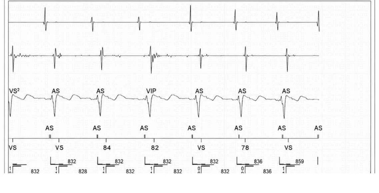 Abbott ICD electrogram, segment 4 of 4 — Recent device, lead malfunction, and SecureSense™ algorithm