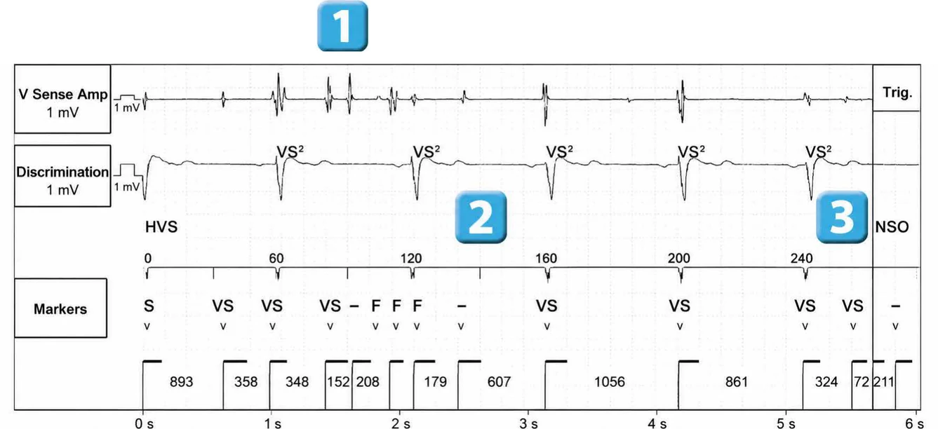 Abbott ICD electrogram, segment 1 of 3 — Recent device, lead malfunction, and SecureSense™ algorithm