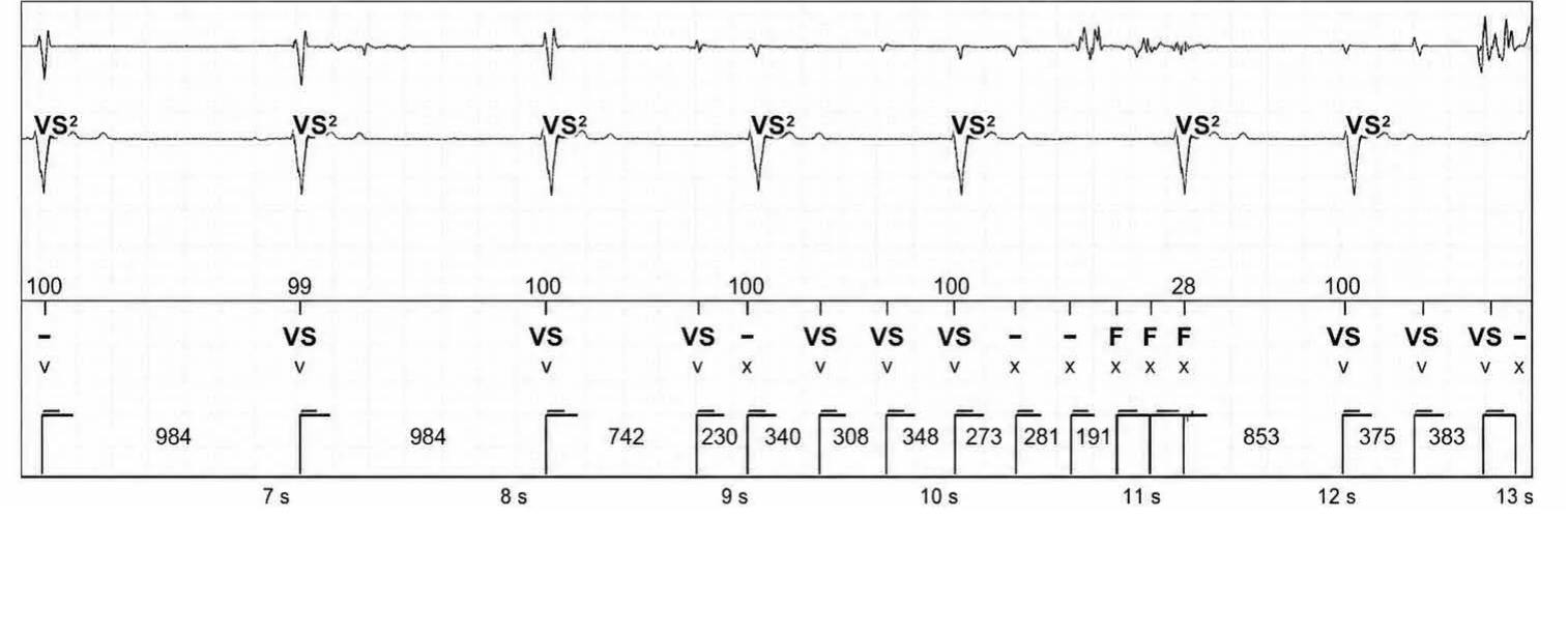Abbott ICD electrogram, segment 2 of 3 — Recent device, lead malfunction, and SecureSense™ algorithm