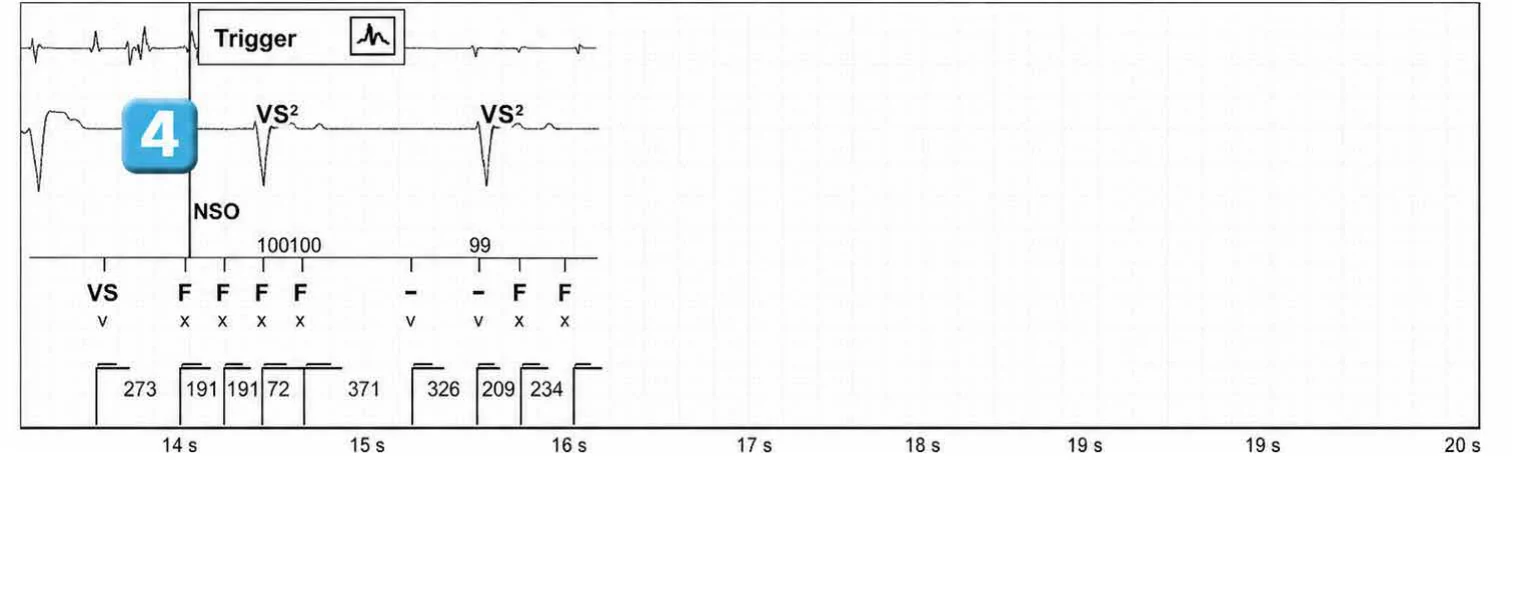 Abbott ICD electrogram, segment 3 of 3 — Recent device, lead malfunction, and SecureSense™ algorithm