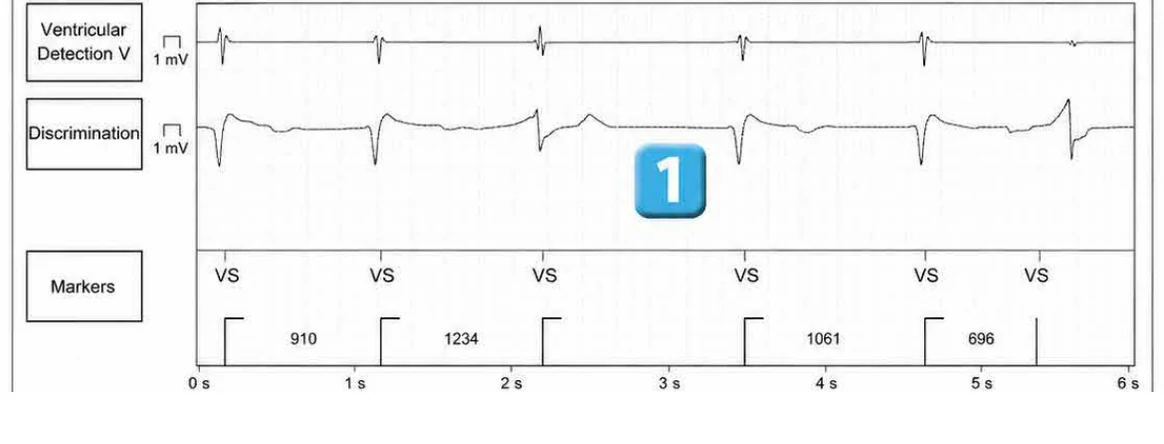 Abbott ICD electrogram, segment 1 of 6 — Lead malfunction revealed by an electric shock
