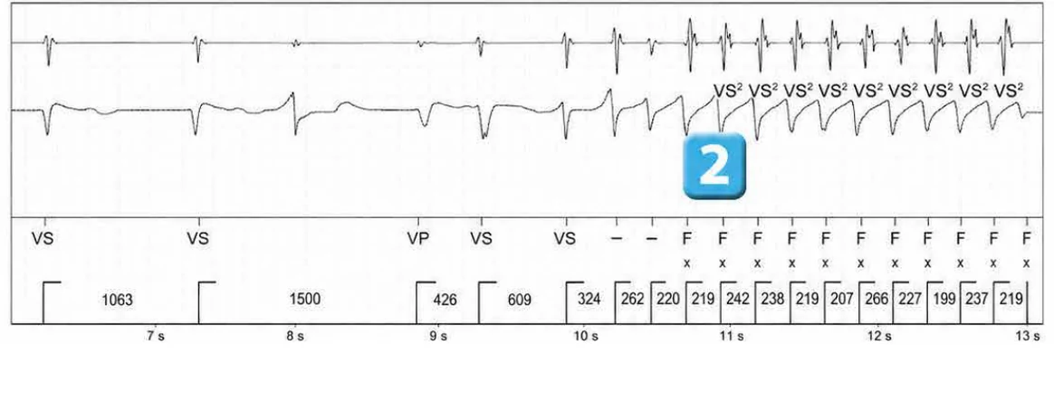 Abbott ICD electrogram, segment 2 of 6 — Lead malfunction revealed by an electric shock