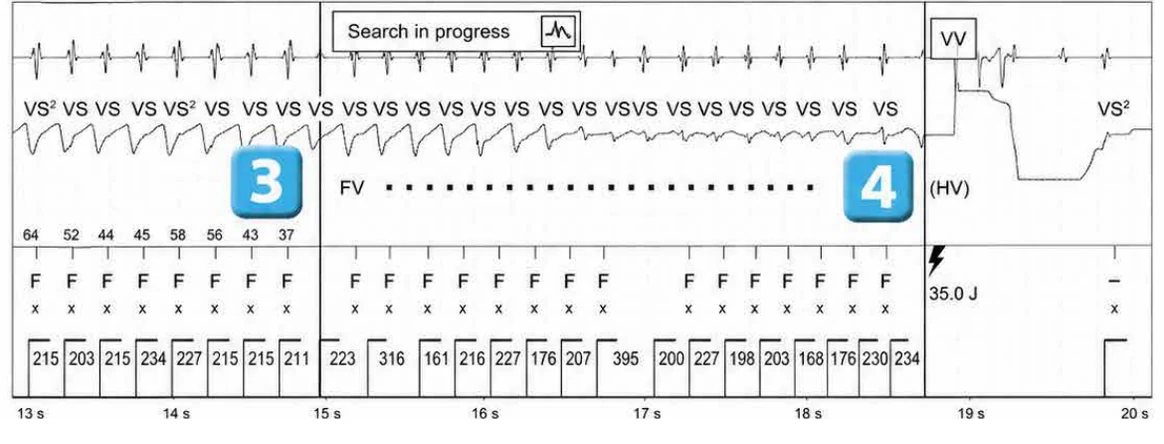 Abbott ICD electrogram, segment 3 of 6 — Lead malfunction revealed by an electric shock