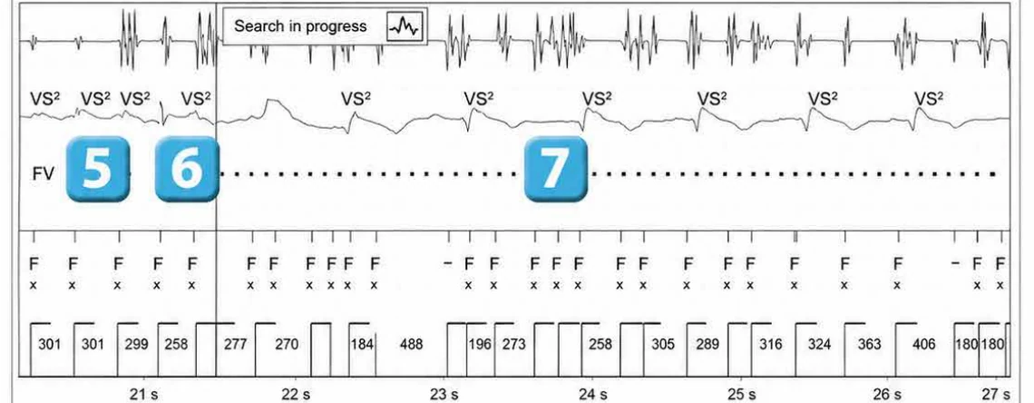 Abbott ICD electrogram, segment 4 of 6 — Lead malfunction revealed by an electric shock