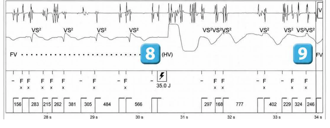 Abbott ICD electrogram, segment 5 of 6 — Lead malfunction revealed by an electric shock