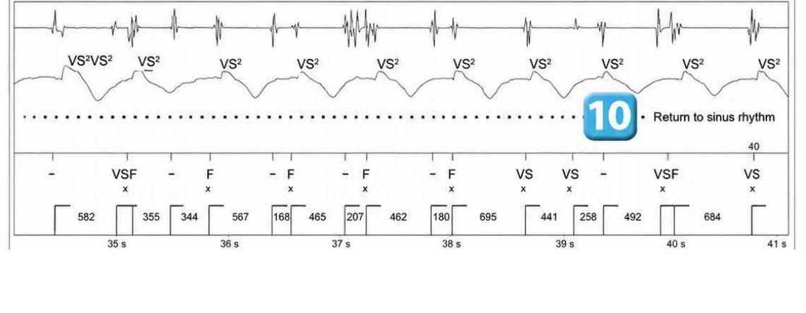 Abbott ICD electrogram, segment 6 of 6 — Lead malfunction revealed by an electric shock