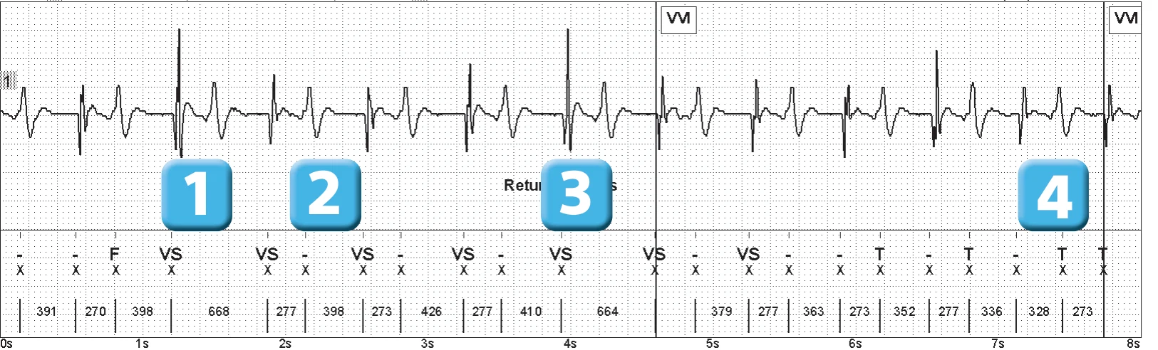 Abbott ICD electrogram, segment 1 of 4 — Oversensing of the T wave on an older model