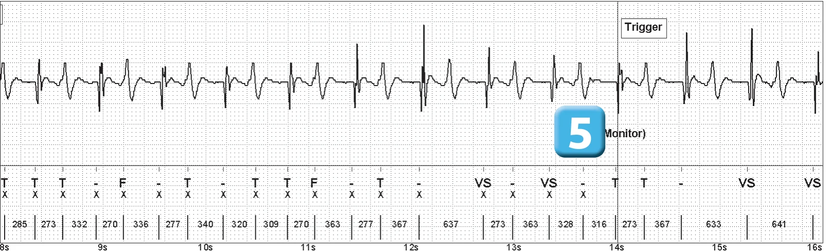 Abbott ICD electrogram, segment 2 of 4 — Oversensing of the T wave on an older model