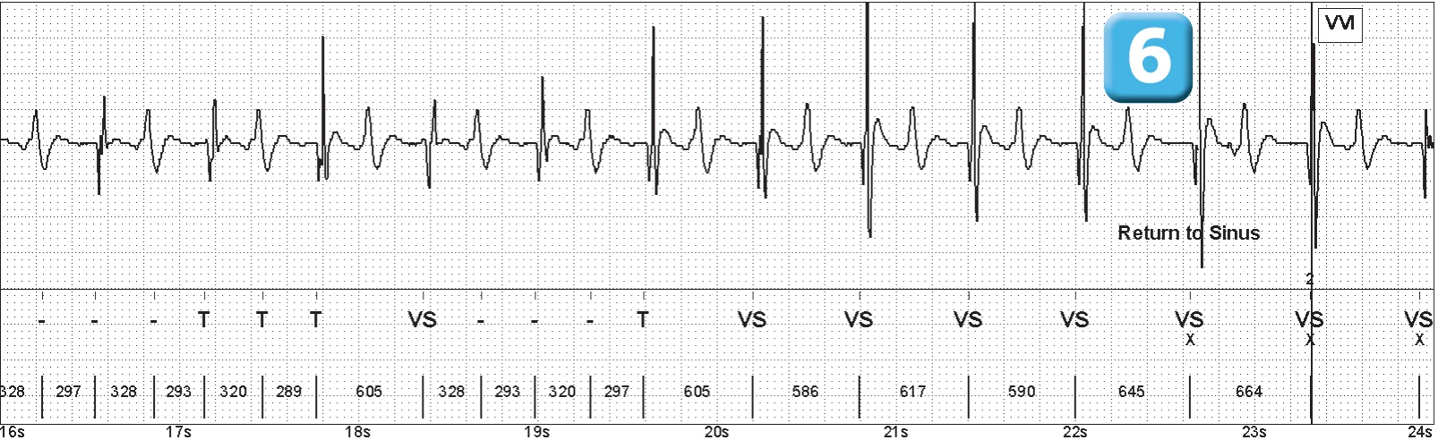 Abbott ICD electrogram, segment 3 of 4 — Oversensing of the T wave on an older model