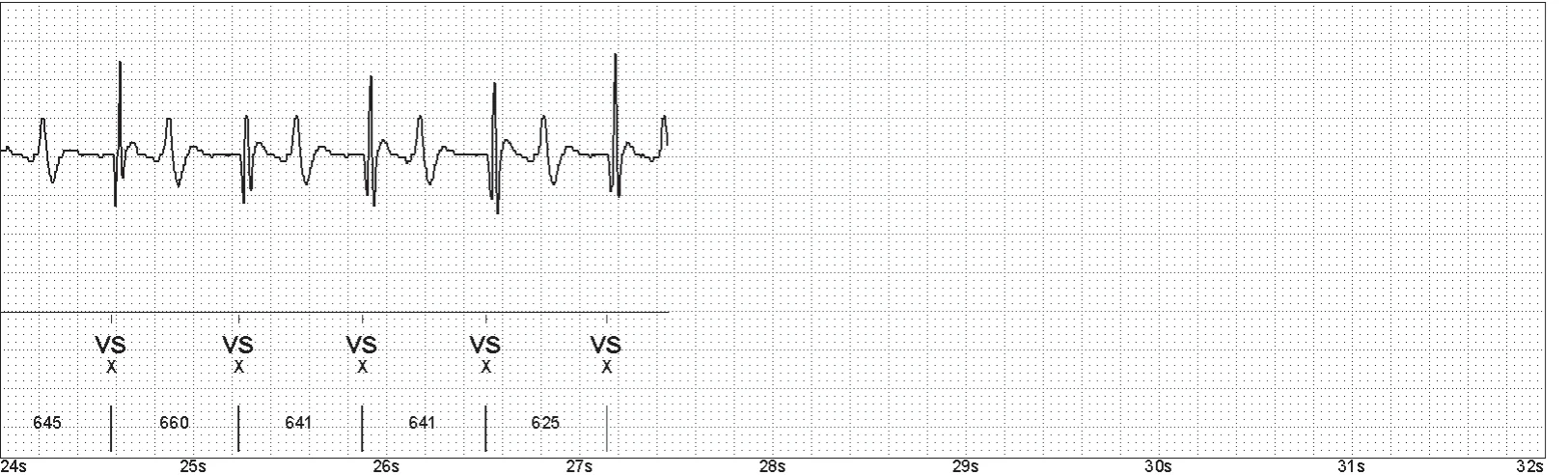 Abbott ICD electrogram, segment 4 of 4 — Oversensing of the T wave on an older model