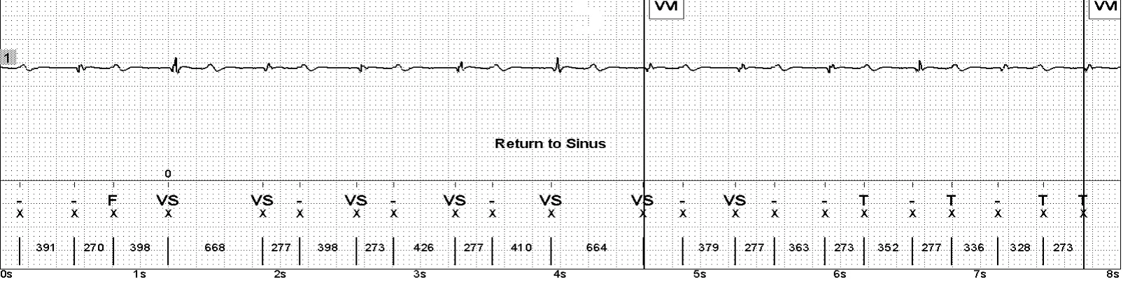Abbott ICD electrogram, segment 1 of 4 — Oversensing of the T wave on an older model