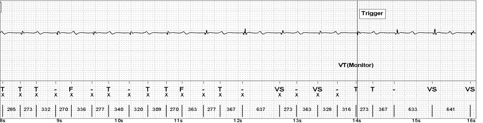 Abbott ICD electrogram, segment 2 of 4 — Oversensing of the T wave on an older model