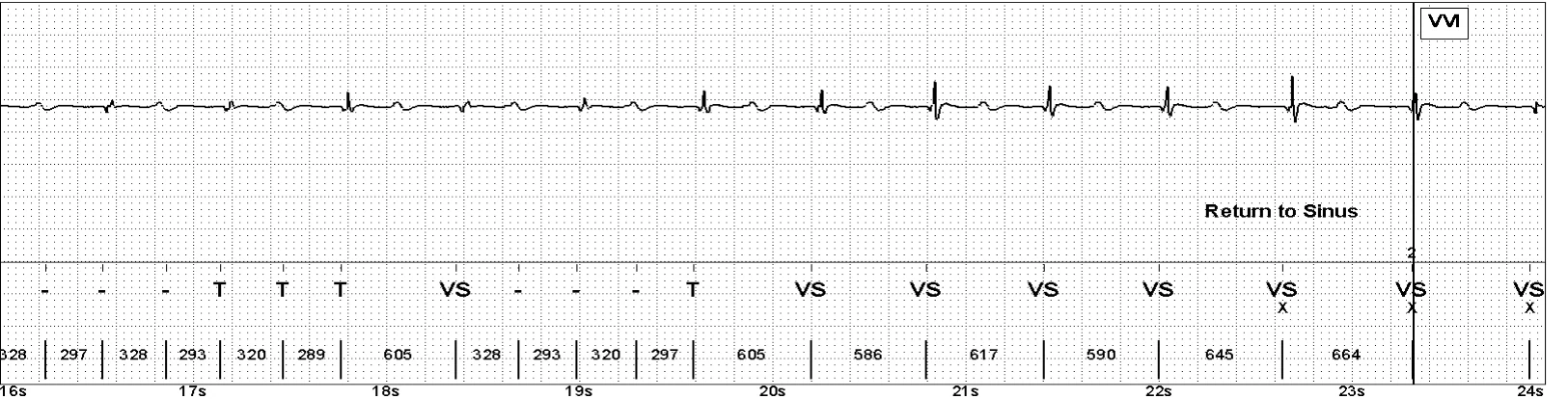 Abbott ICD electrogram, segment 3 of 4 — Oversensing of the T wave on an older model