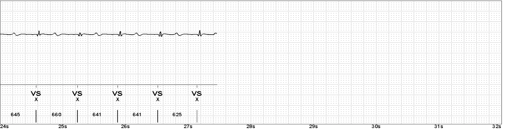 Abbott ICD electrogram, segment 4 of 4 — Oversensing of the T wave on an older model