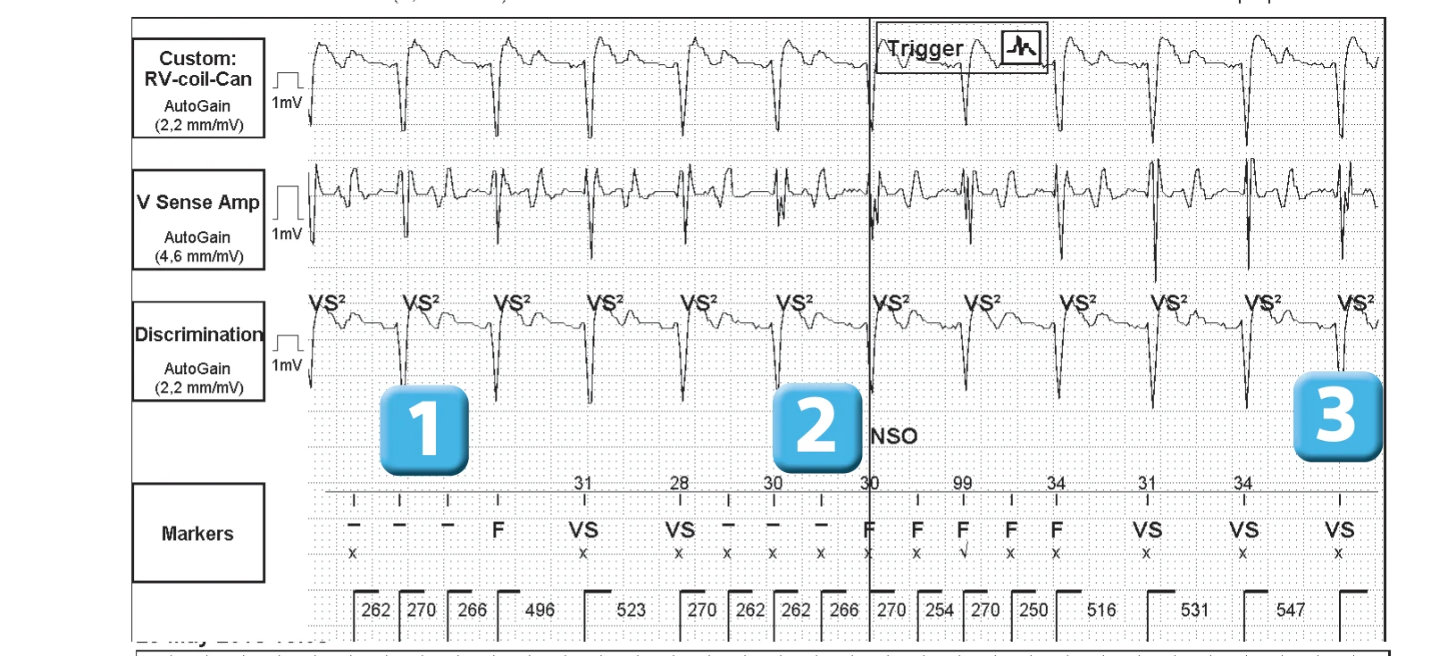 Abbott ICD electrogram, segment 1 of 3 — New device, T wave oversensing, and SecureSense™ algorithm