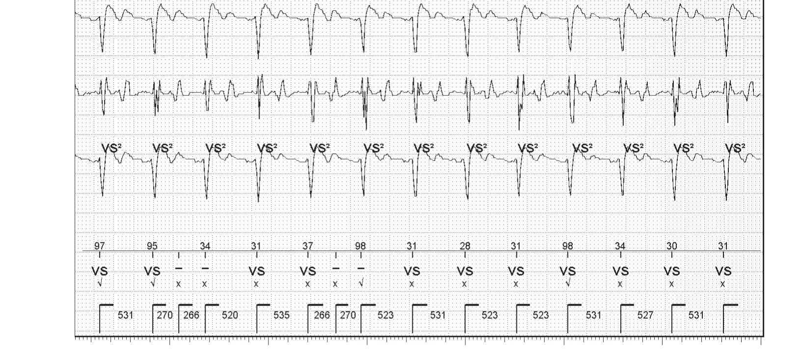 Abbott ICD electrogram, segment 2 of 3 — New device, T wave oversensing, and SecureSense™ algorithm