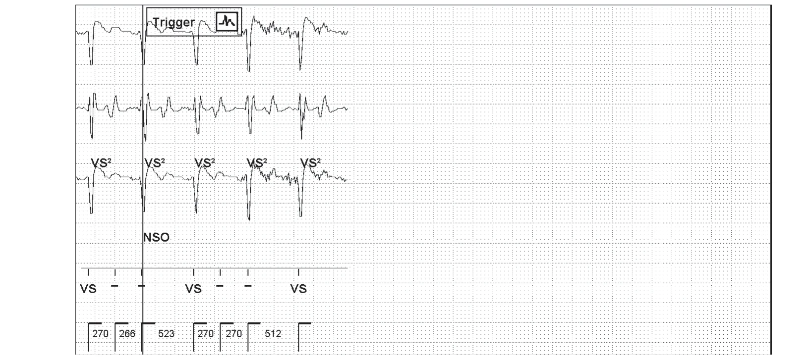 Abbott ICD electrogram, segment 3 of 3 — New device, T wave oversensing, and SecureSense™ algorithm