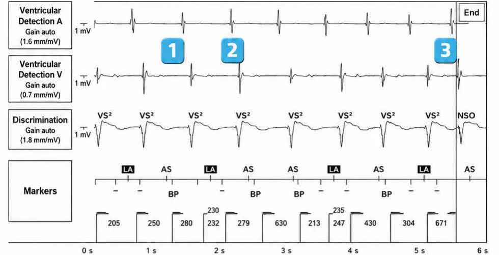 Abbott ICD electrogram, segment 1 of 3 — New device, post-stimulation T wave oversensing, and SecureSense™ algorithm