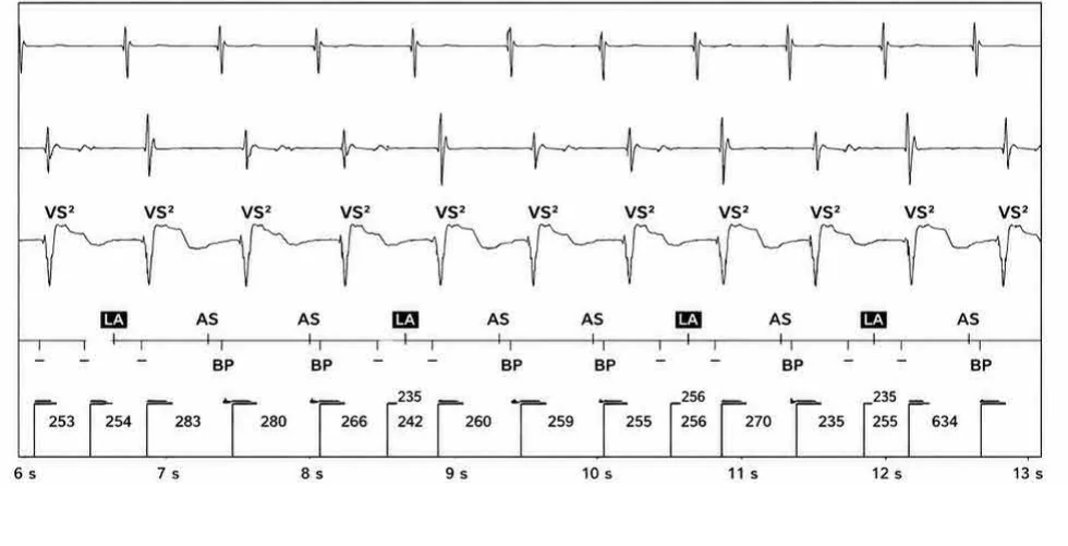 Abbott ICD electrogram, segment 2 of 3 — New device, post-stimulation T wave oversensing, and SecureSense™ algorithm