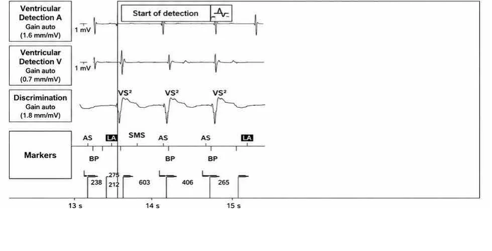 Abbott ICD electrogram, segment 3 of 3 — New device, post-stimulation T wave oversensing, and SecureSense™ algorithm
