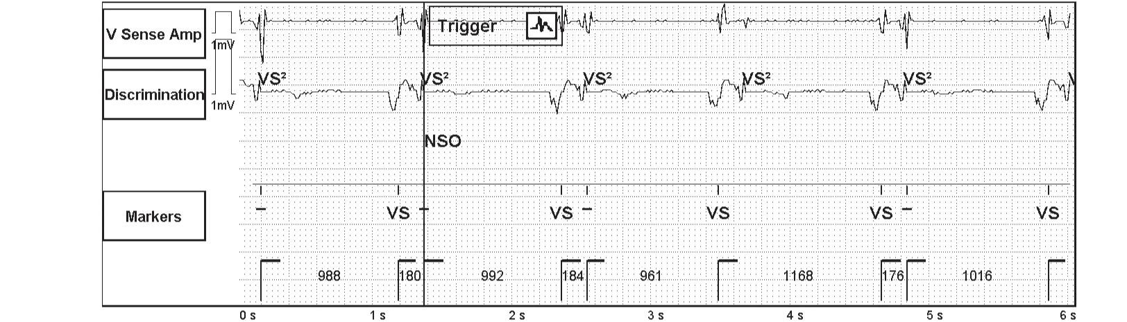 Abbott ICD electrogram, segment 1 of 3 — Recent device, P wave oversensing, and SecureSense™ algorithm