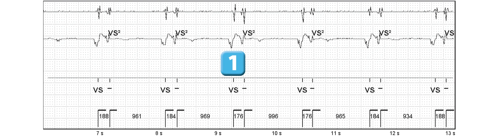 Abbott ICD electrogram, segment 2 of 3 — Recent device, P wave oversensing, and SecureSense™ algorithm