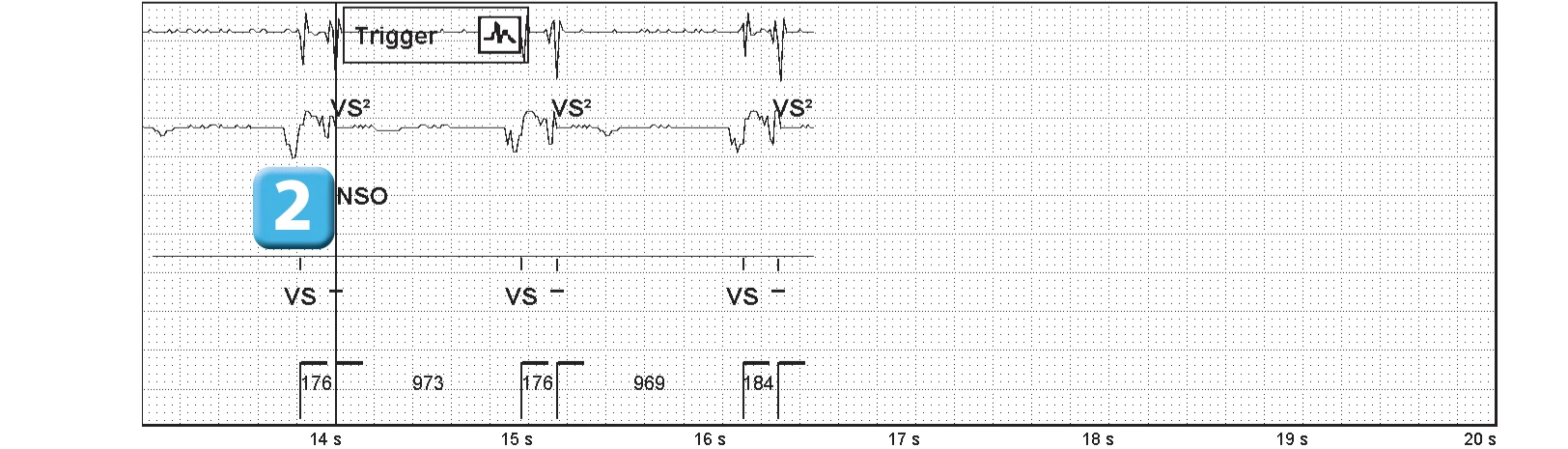 Abbott ICD electrogram, segment 3 of 3 — Recent device, P wave oversensing, and SecureSense™ algorithm