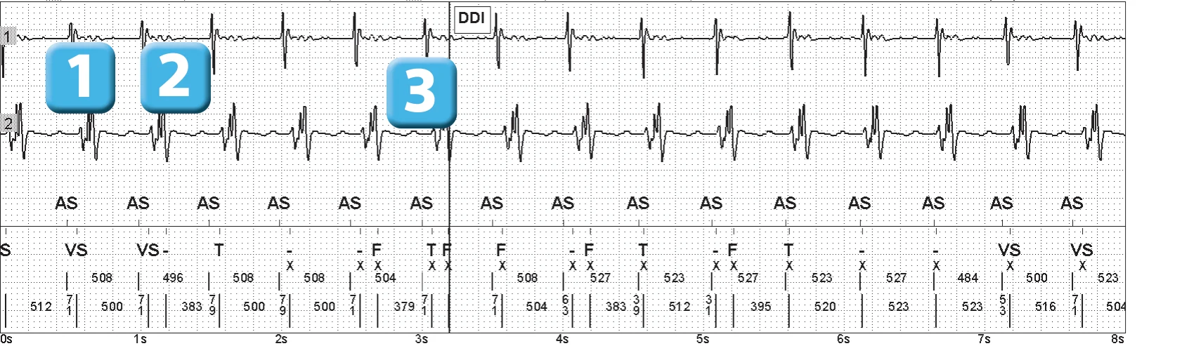 Abbott ICD electrogram, segment 1 of 5 — Double counting of the R wave on an older model