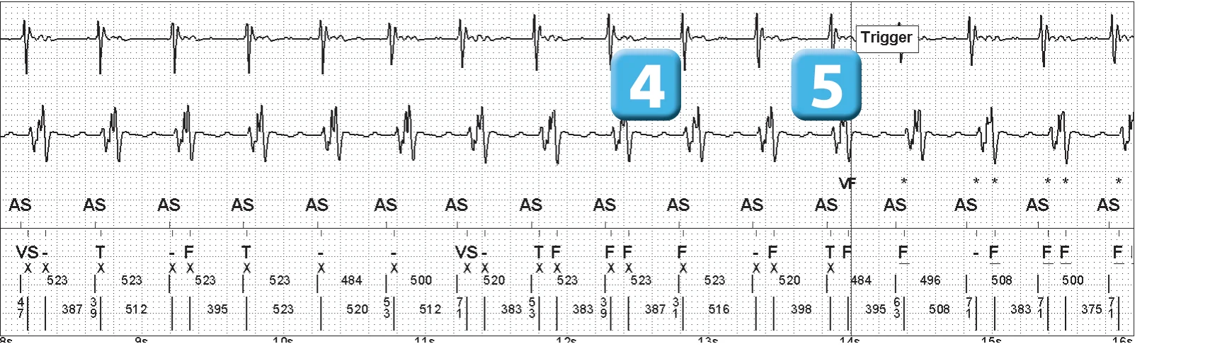 Abbott ICD electrogram, segment 2 of 5 — Double counting of the R wave on an older model