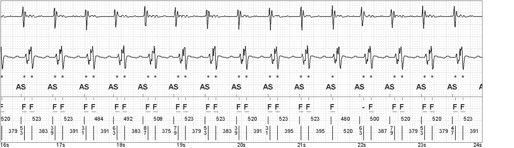 Abbott ICD electrogram, segment 3 of 5 — Double counting of the R wave on an older model