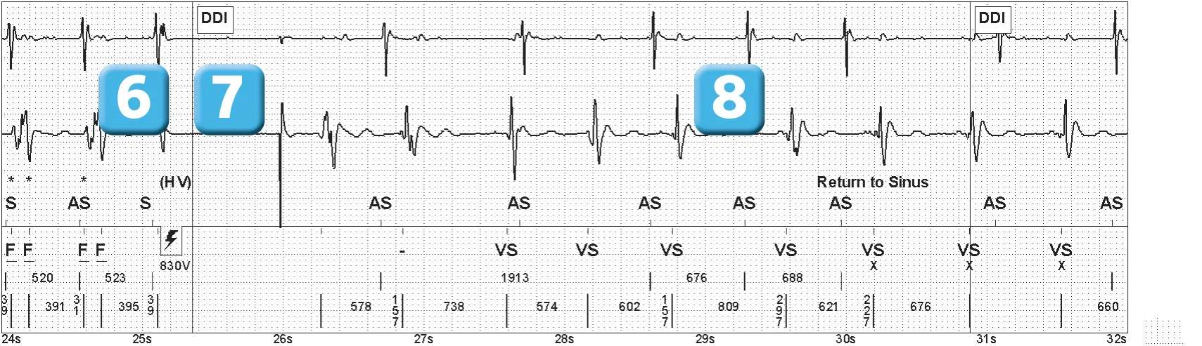 Abbott ICD electrogram, segment 4 of 5 — Double counting of the R wave on an older model
