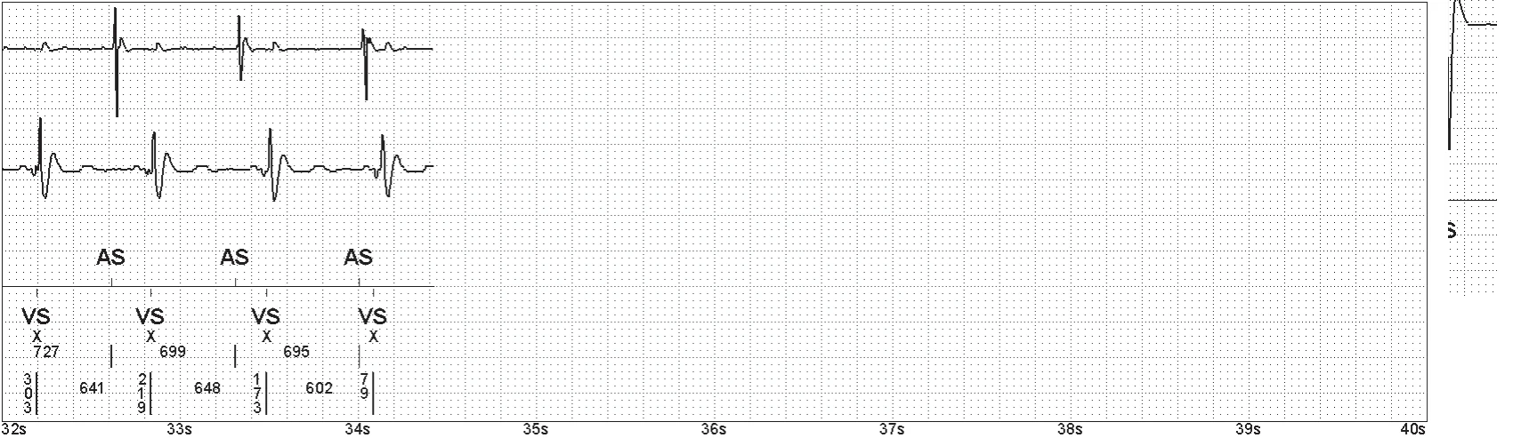 Abbott ICD electrogram, segment 5 of 5 — Double counting of the R wave on an older model