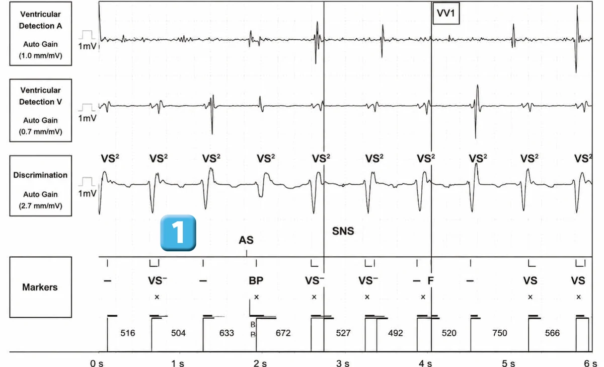 Abbott ICD electrogram, segment 1 of 3 — New device, dual R-wave counting and SecureSense™ algorithm